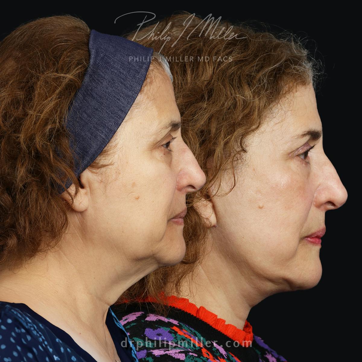 Fat Injections Before & After Gallery - Patient 172159650 - Image 2