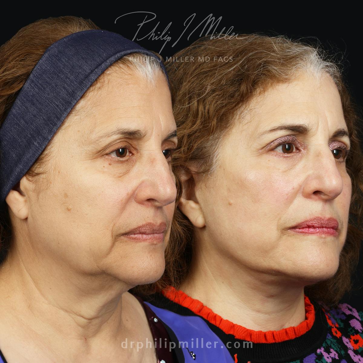 Facelift/NatraLift Before & After Gallery - Patient 172159639 - Image 2
