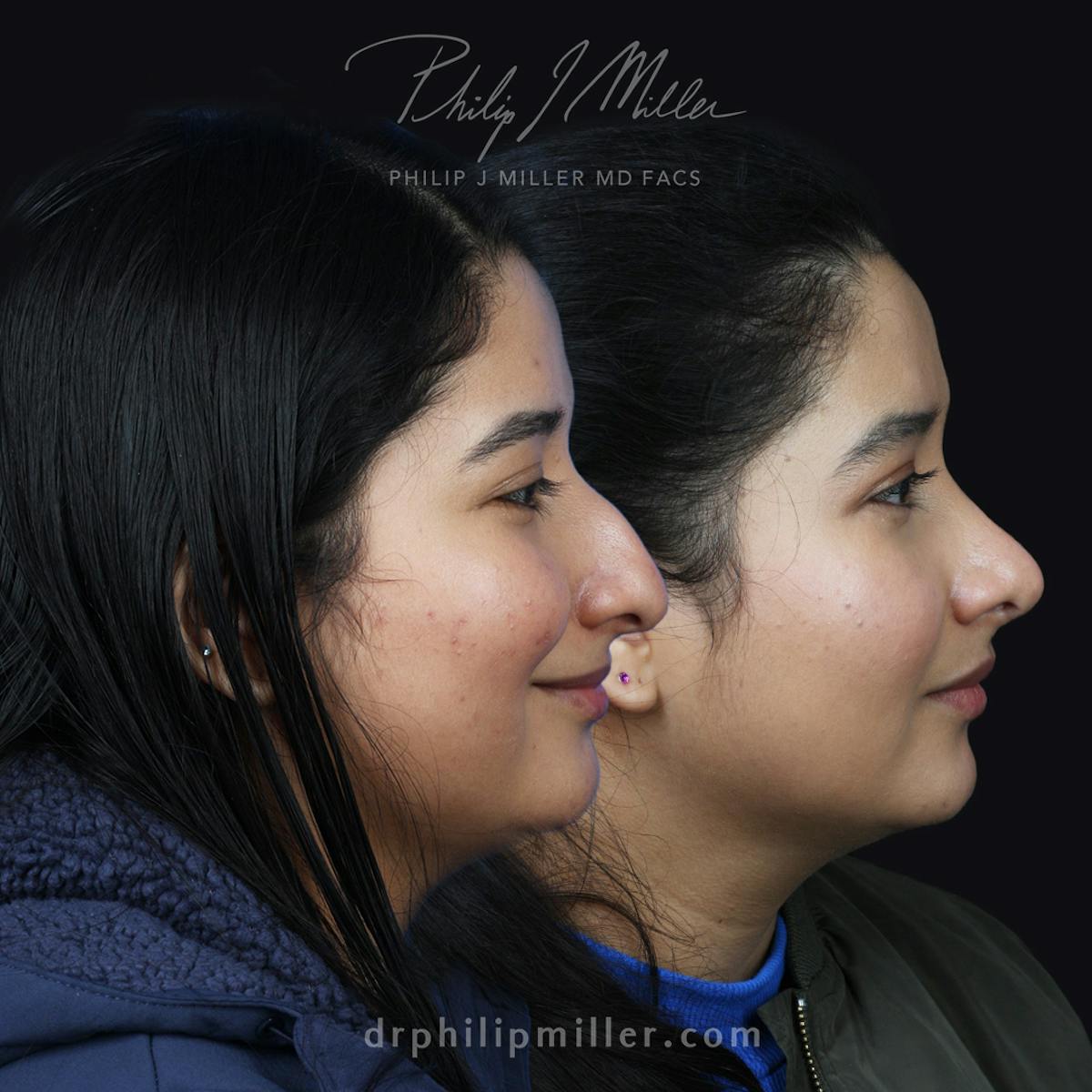 Rhinoplasty/NatraNose Before & After Gallery - Patient 172505513 - Image 2
