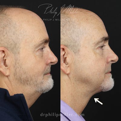 G. I. Jaw/Chin Contouring Before & After Gallery - Patient 179248627 - Image 1