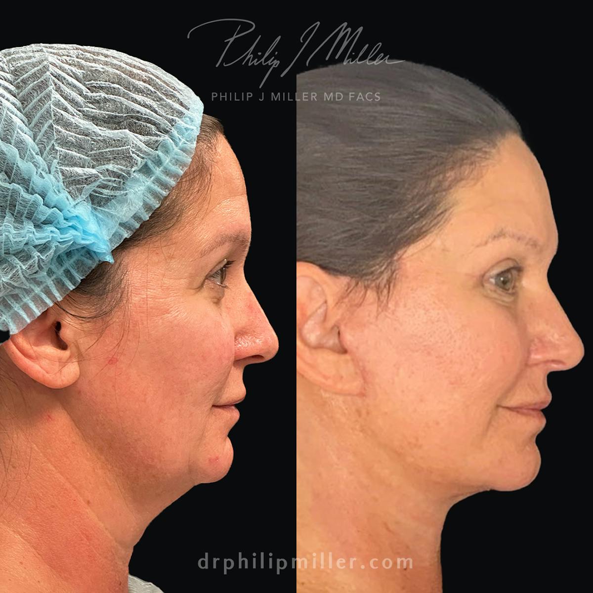 Facelift/NatraLift Before & After Gallery - Patient 165340100 - Image 2