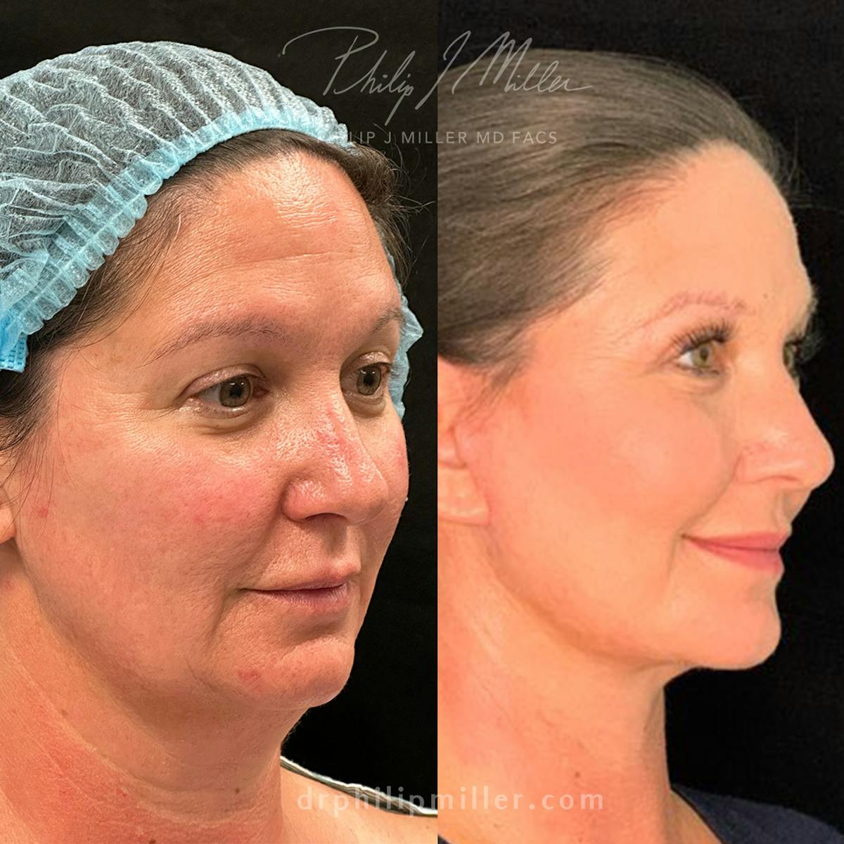 Facelift/NatraLift Before & After Gallery - Patient 165340100 - Image 3