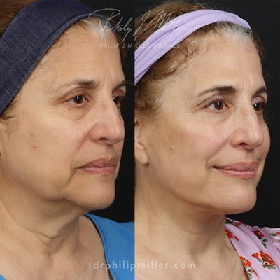 Facelift/NatraLift Before & After Gallery - Patient 172159639 - Image 1