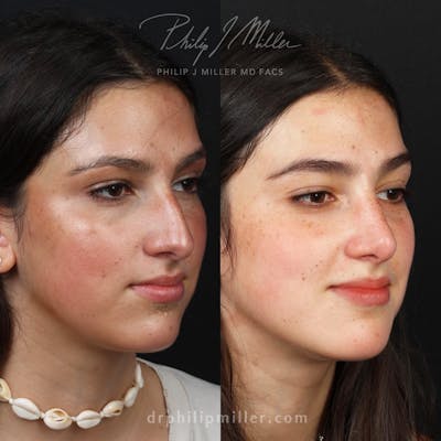 Rhinoplasty/NatraNose Before & After Gallery - Patient 192958690 - Image 1