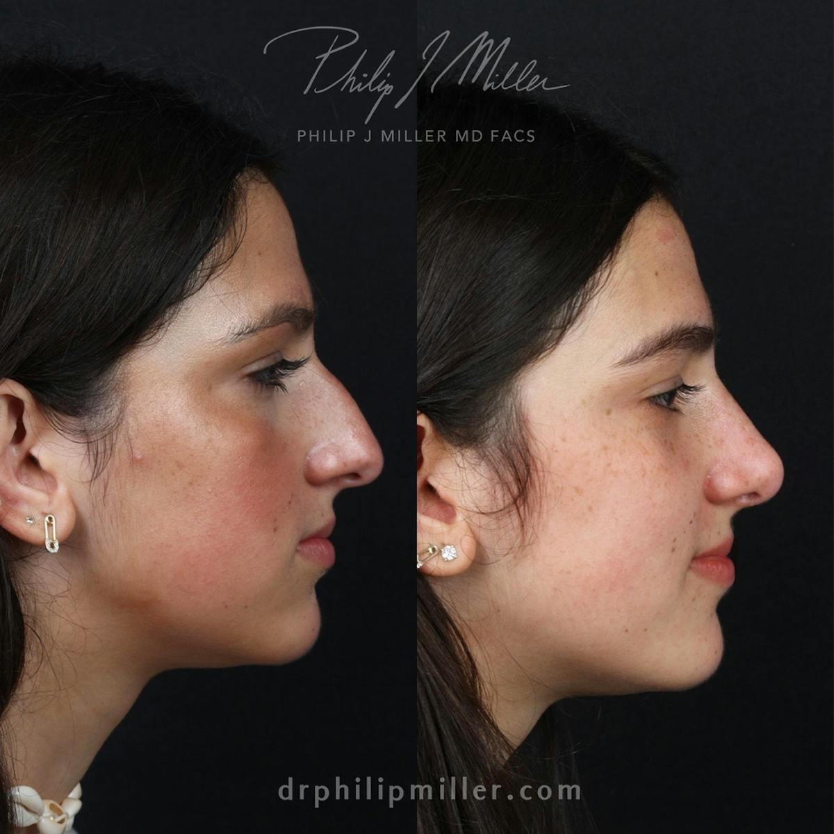 Rhinoplasty/NatraNose Before & After Gallery - Patient 192958690 - Image 2