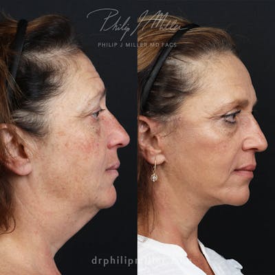 Facelift/NatraLift Before & After Gallery - Patient 196276801 - Image 1