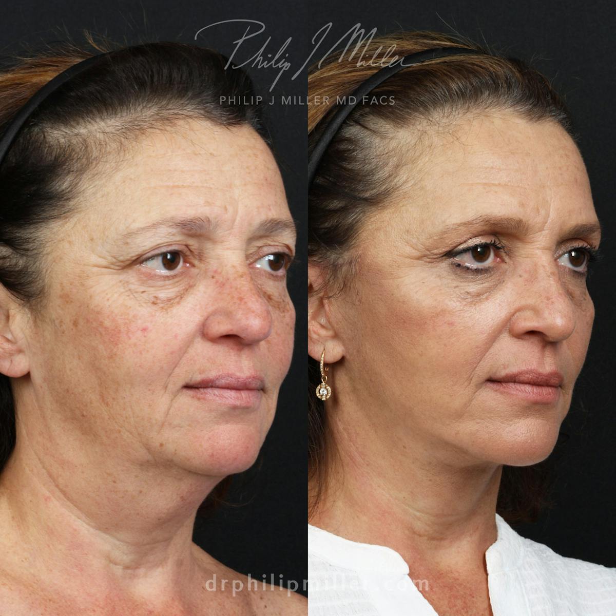 Facelift/NatraLift Before & After Gallery - Patient 196276801 - Image 2