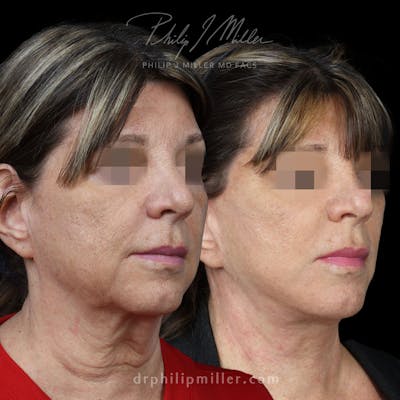 Facelift/NatraLift Before & After Gallery - Patient 196744145 - Image 1
