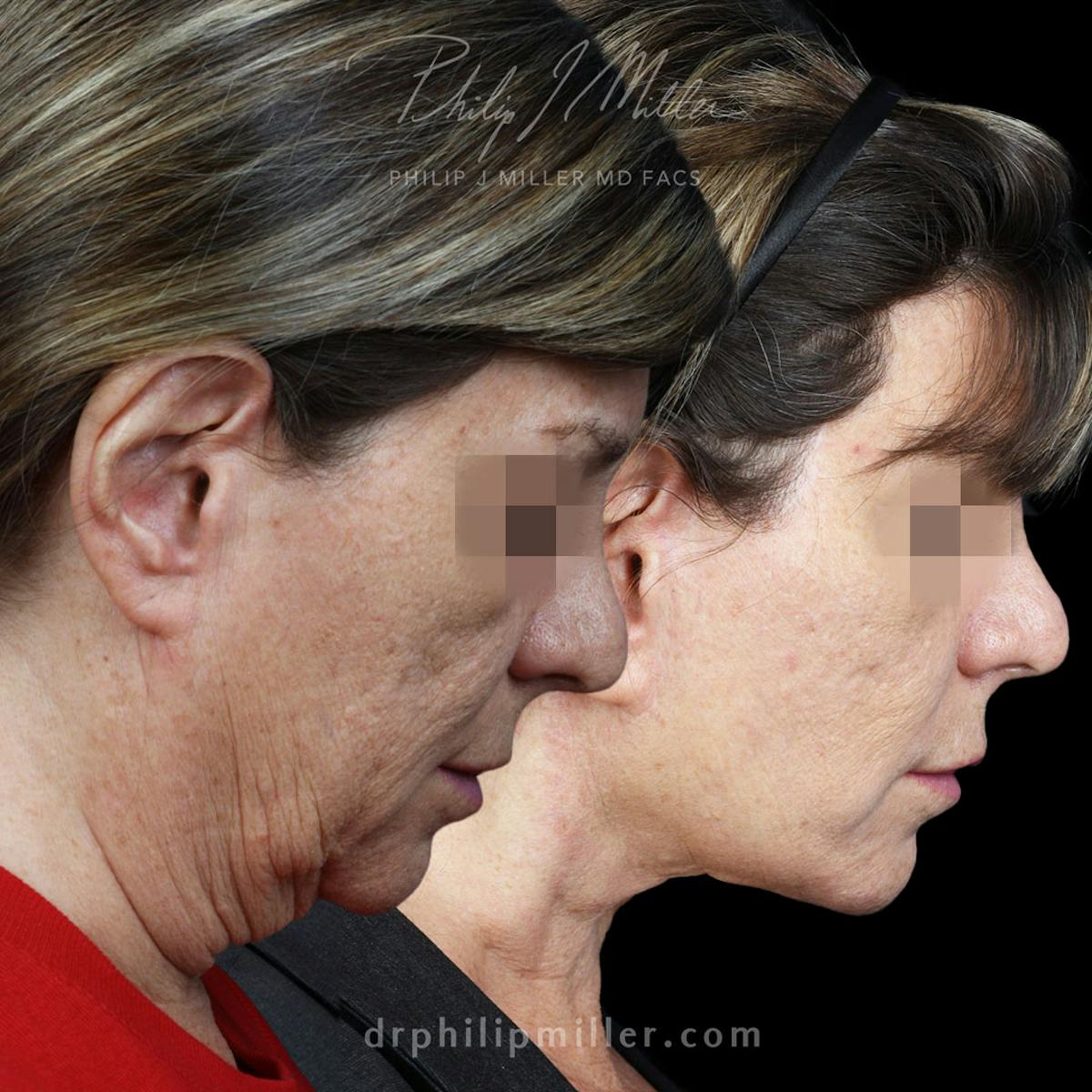 Facelift/NatraLift Before & After Gallery - Patient 196744145 - Image 2