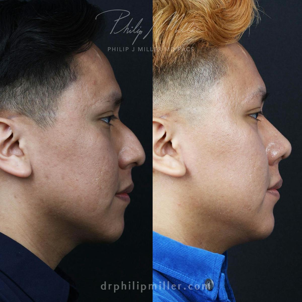 Rhinoplasty/NatraNose Before & After Gallery - Patient 198593838 - Image 2