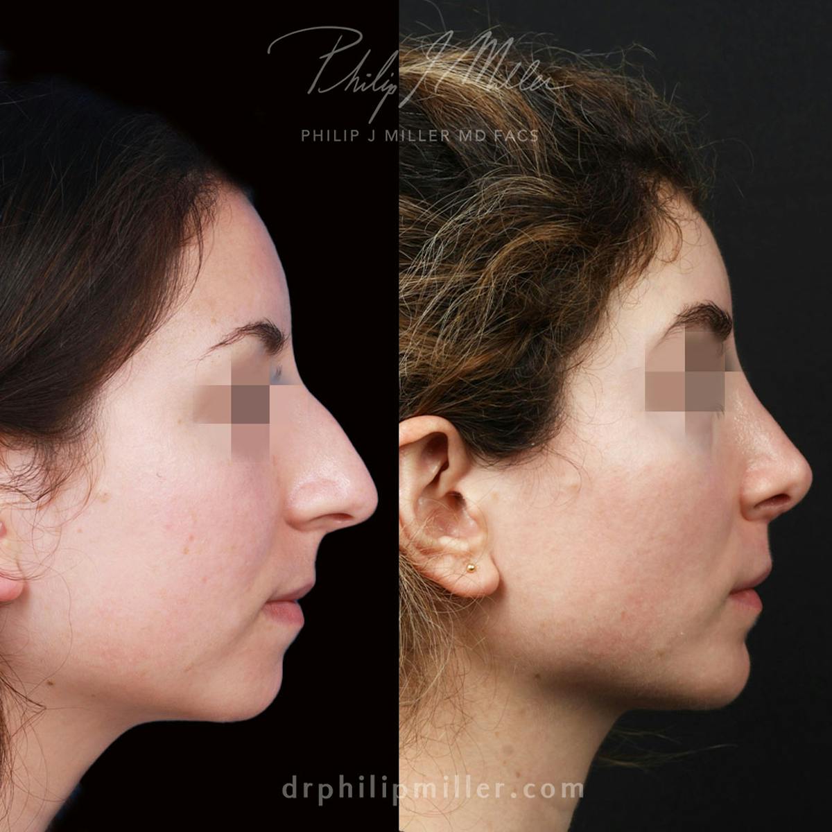 Revision Rhinoplasty Before & After Gallery - Patient 325905 - Image 1