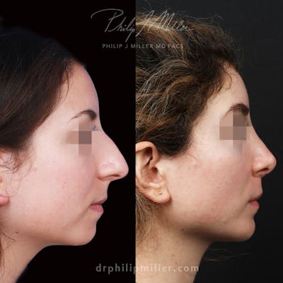 Revision Rhinoplasty Before & After Gallery - Patient 325905 - Image 1