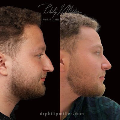 Rhinoplasty/NatraNose Before & After Gallery - Patient 723490 - Image 1