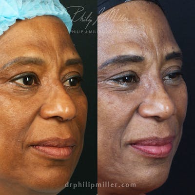 Rhinoplasty/NatraNose Before & After Gallery - Patient 556478 - Image 1