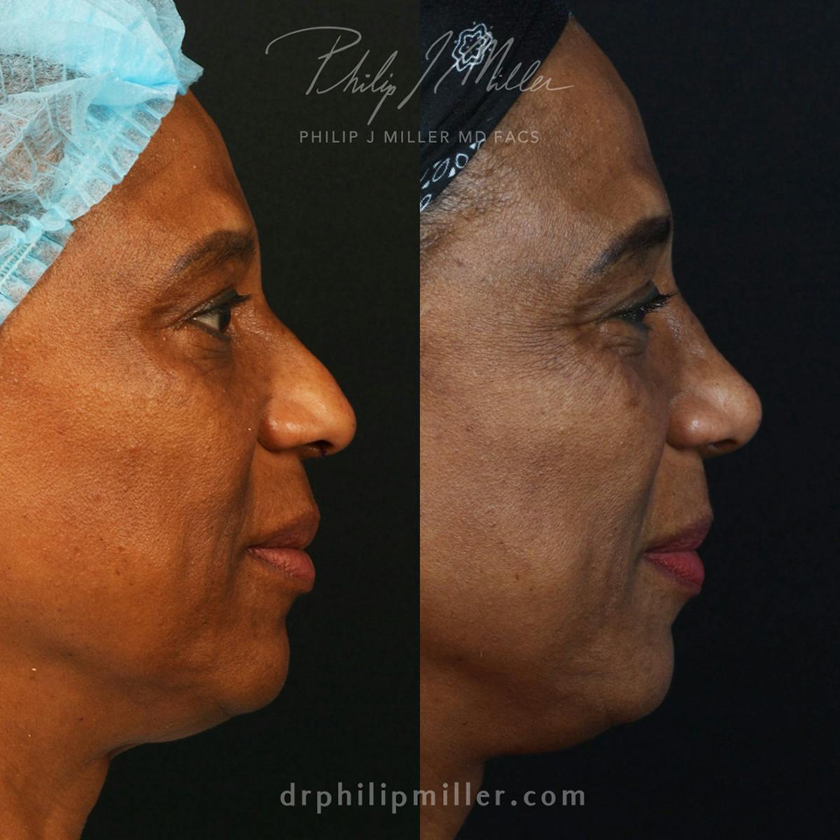 Rhinoplasty/NatraNose Before & After Gallery - Patient 556478 - Image 2