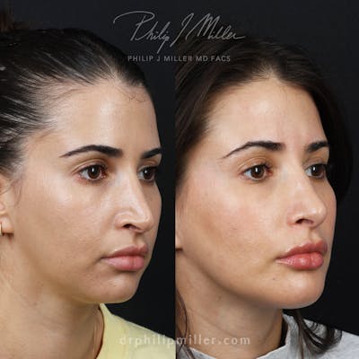 Rhinoplasty/NatraNose Before & After Gallery - Patient 529019 - Image 1