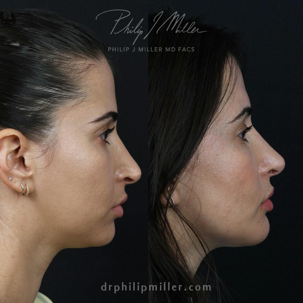Rhinoplasty/NatraNose Before & After Gallery - Patient 529019 - Image 2