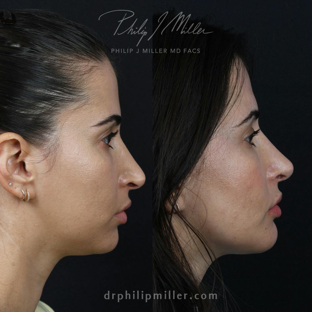 Rhinoplasty/NatraNose Before & After Gallery - Patient 529019 - Image 2