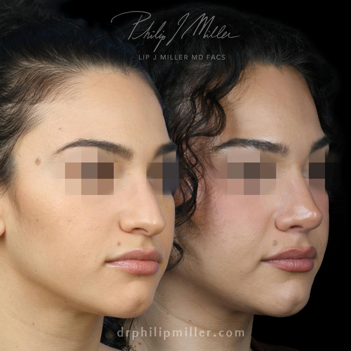 Rhinoplasty/NatraNose Before & After Gallery - Patient 376869 - Image 2