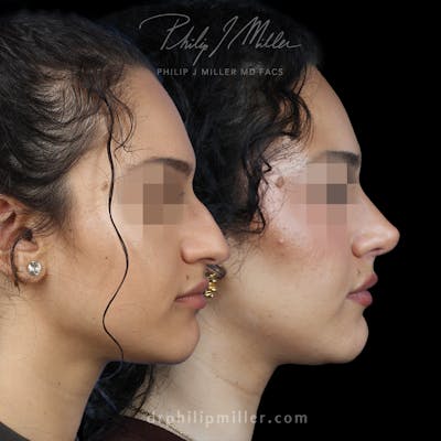 Rhinoplasty/NatraNose Before & After Gallery - Patient 376869 - Image 1