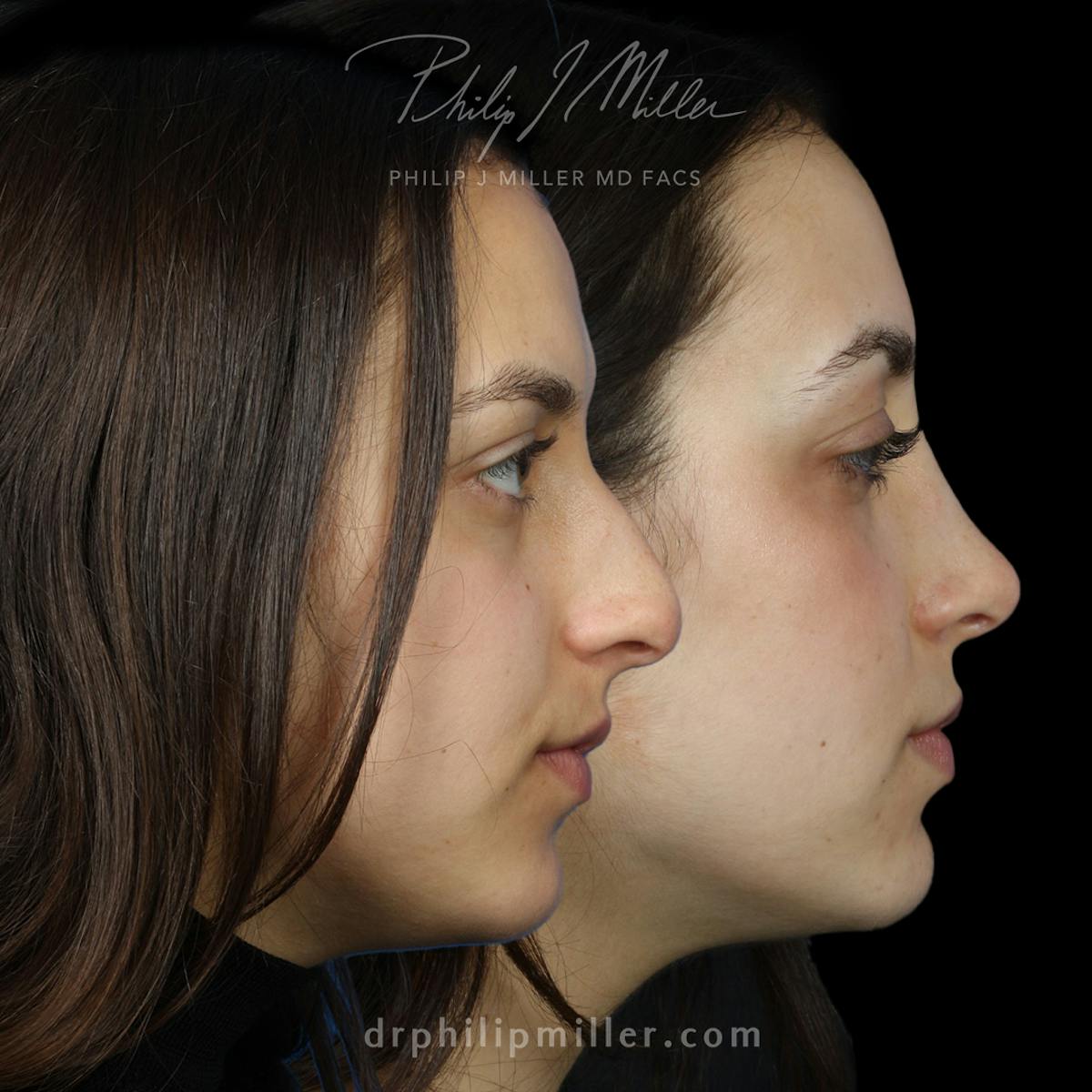 Rhinoplasty/NatraNose Before & After Gallery - Patient 136047 - Image 3