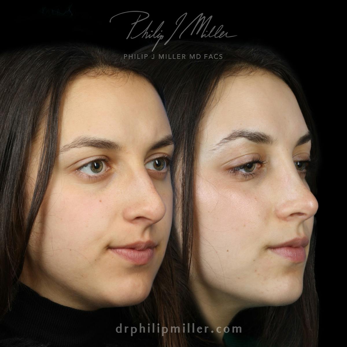 Rhinoplasty/NatraNose Before & After Gallery - Patient 136047 - Image 2