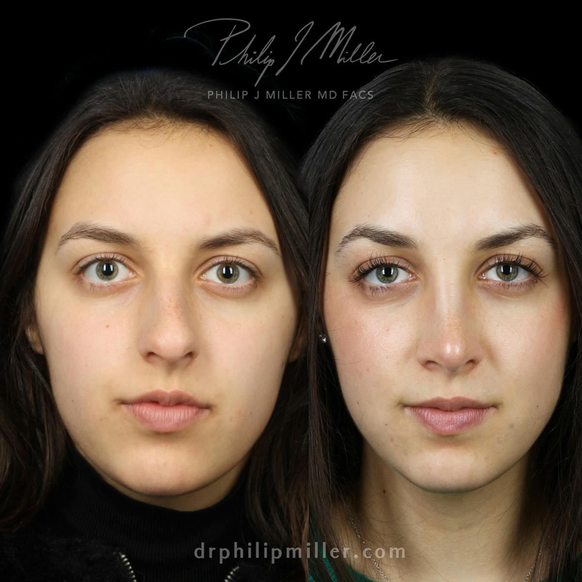 Rhinoplasty/NatraNose Before & After Gallery - Patient 136047 - Image 1