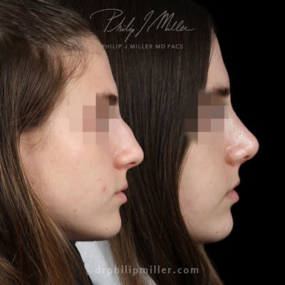 Rhinoplasty/NatraNose Before & After Gallery - Patient 143011 - Image 1