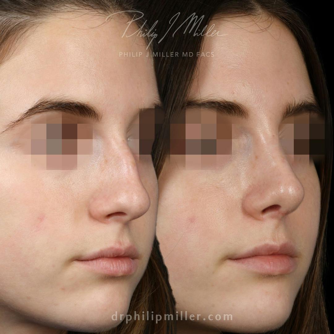 Rhinoplasty/NatraNose Before & After Gallery - Patient 143011 - Image 2