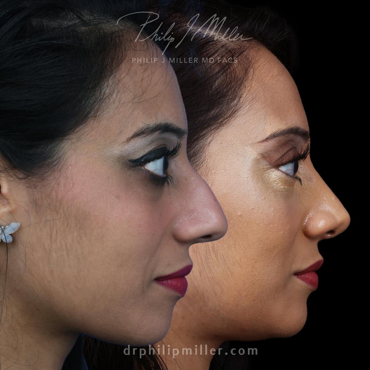 Rhinoplasty/NatraNose Before & After Gallery - Patient 850440 - Image 2