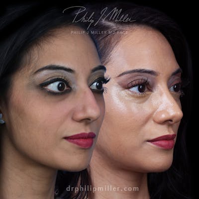 Rhinoplasty/NatraNose Before & After Gallery - Patient 850440 - Image 1