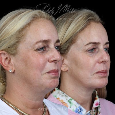Neck Lift Before & After Gallery - Patient 177738 - Image 1