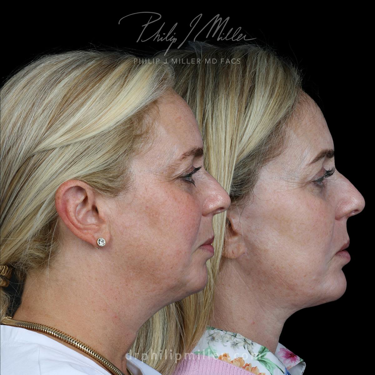 Neck Lift Before & After Gallery - Patient 177738 - Image 2