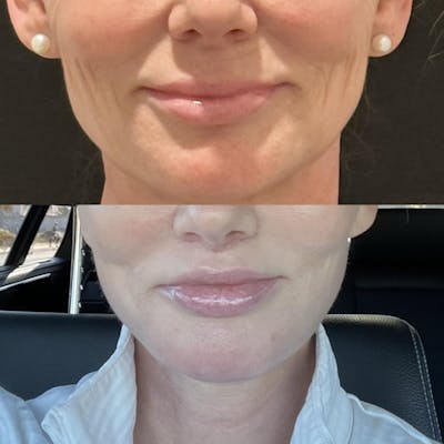 Lip Enhancement Before & After Gallery - Patient 376301 - Image 1