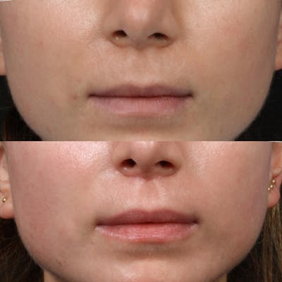Lip Enhancement Before & After Gallery - Patient 304086 - Image 1