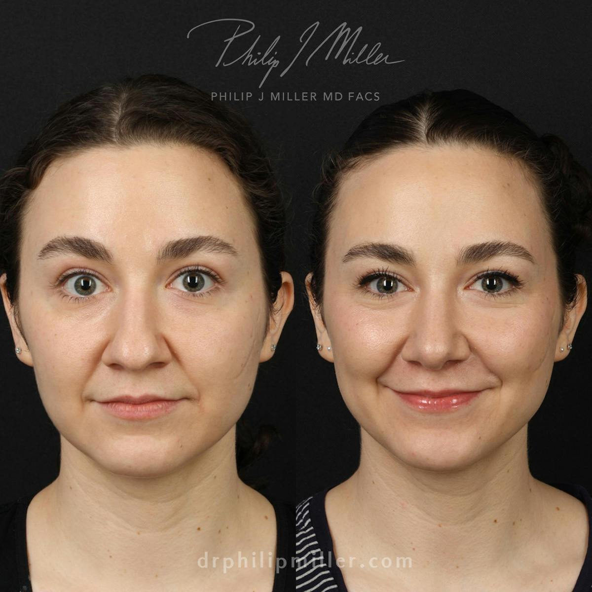 Tipplasty Before & After Gallery - Patient 626244 - Image 1