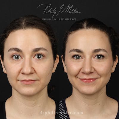 Tipplasty Before & After Gallery - Patient 626244 - Image 1