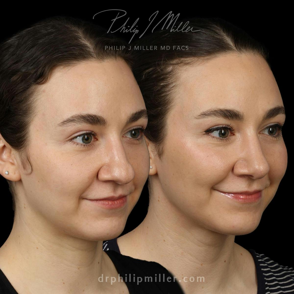 Tipplasty Before & After Gallery - Patient 626244 - Image 2
