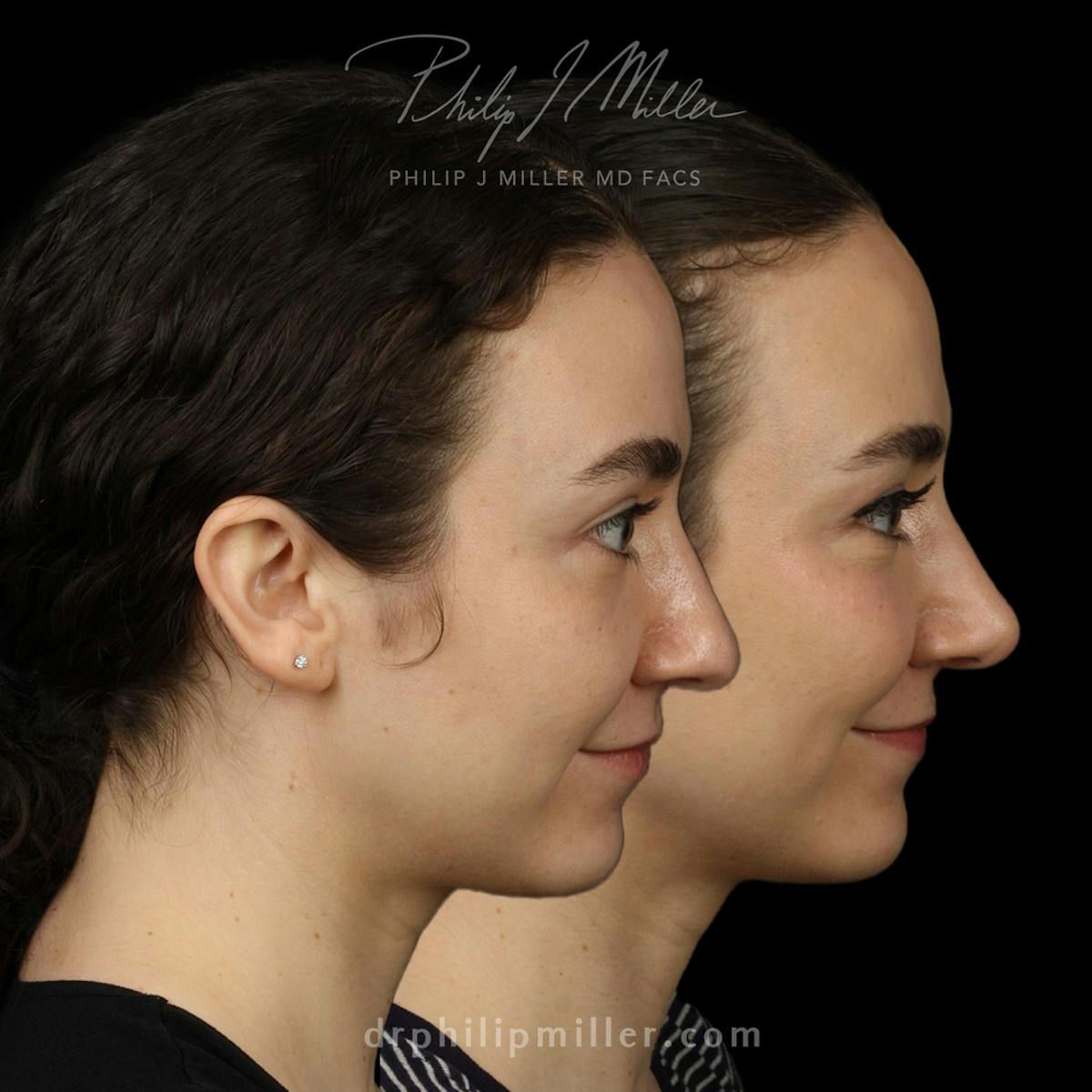 Tipplasty Before & After Gallery - Patient 626244 - Image 3
