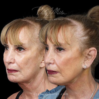 Micro Lift Before & After Gallery - Patient 224390 - Image 1