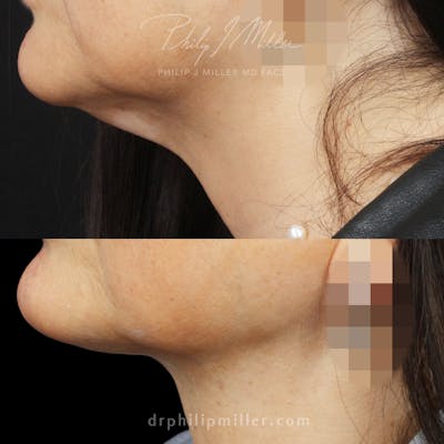 MyEllevate Before & After Gallery - Patient 120229 - Image 1