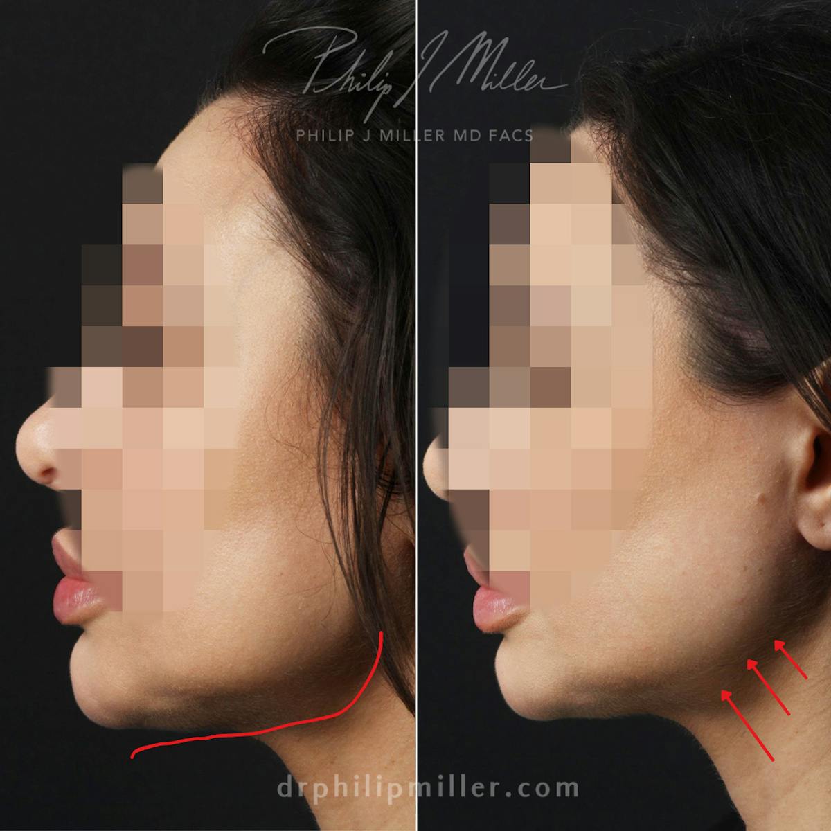 Micro Lift Before & After Gallery - Patient 326332 - Image 2