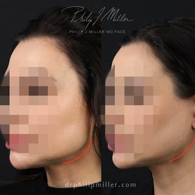 Micro Lift Before & After Gallery - Patient 326332 - Image 1