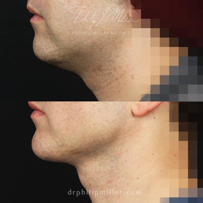 G. I. Jaw/Chin Contouring Before & After Gallery - Patient 396228 - Image 1