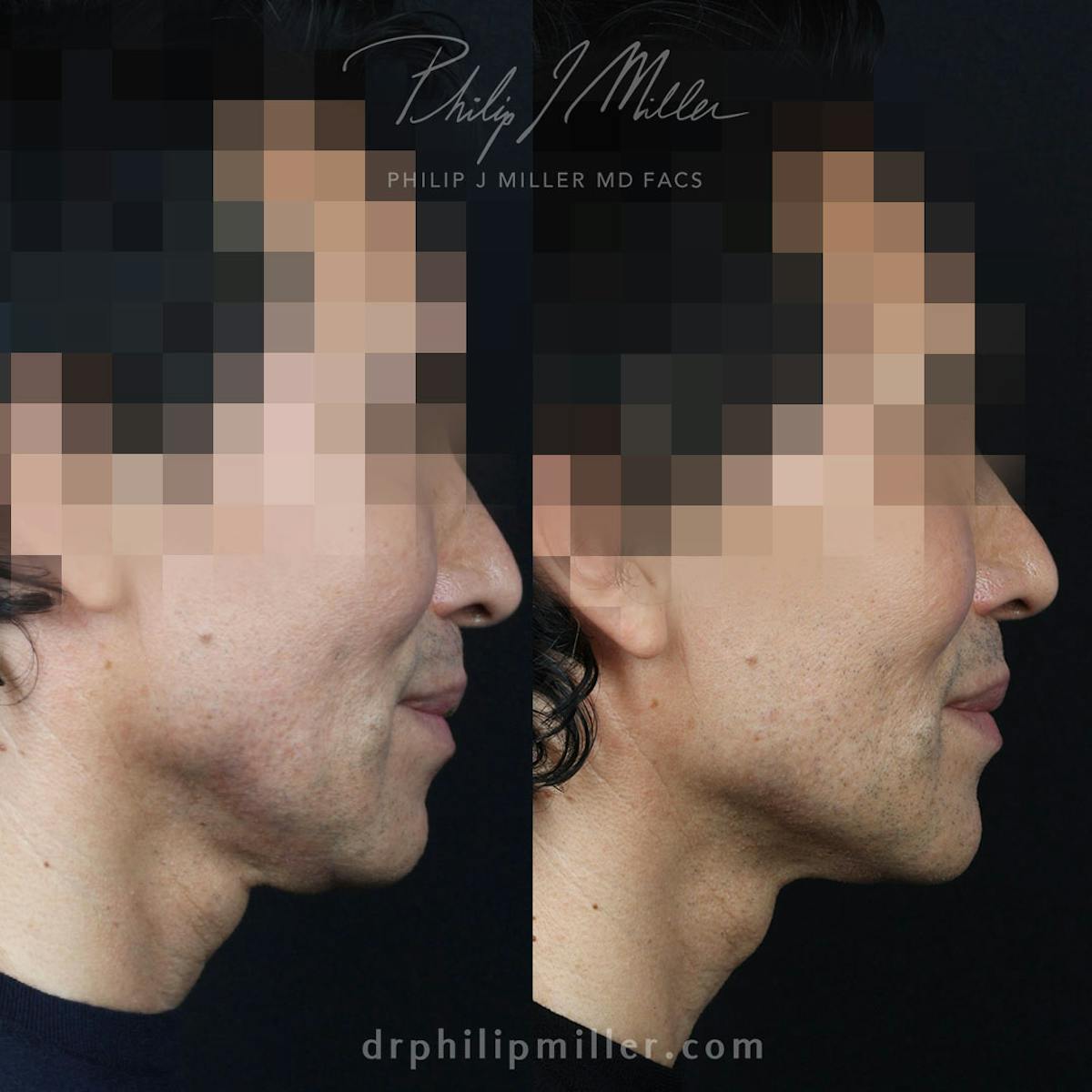 Facelift/NatraLift Before & After Gallery - Patient 585635 - Image 1