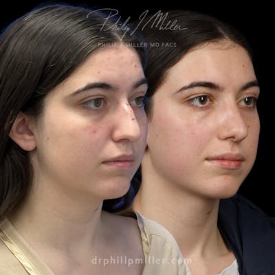 Rhinoplasty/NatraNose Before & After Gallery - Patient 186689 - Image 1