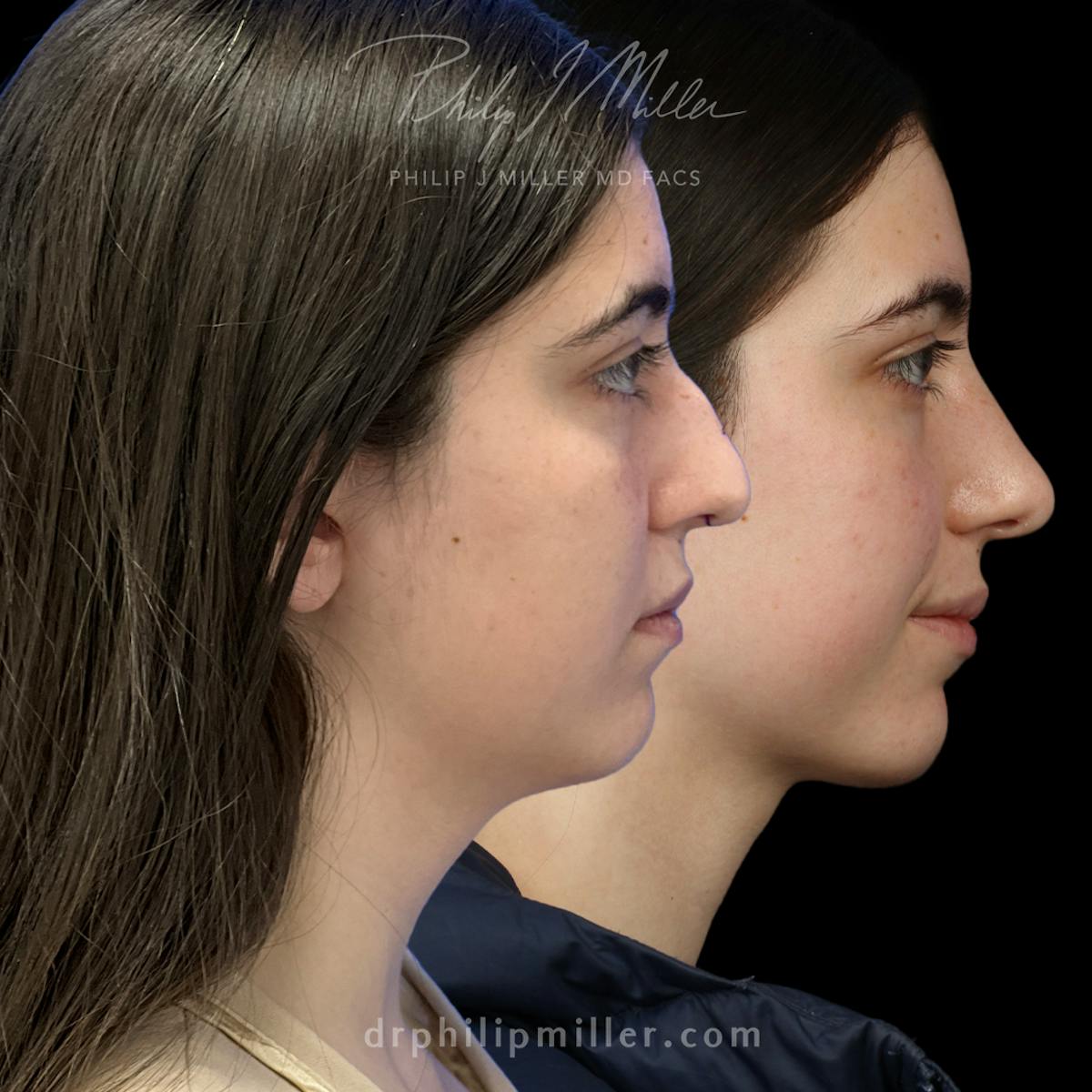 Rhinoplasty/NatraNose Before & After Gallery - Patient 186689 - Image 2