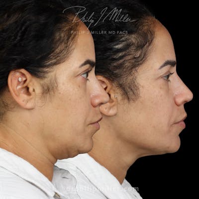 Micro Lift Before & After Gallery - Patient 229317 - Image 1