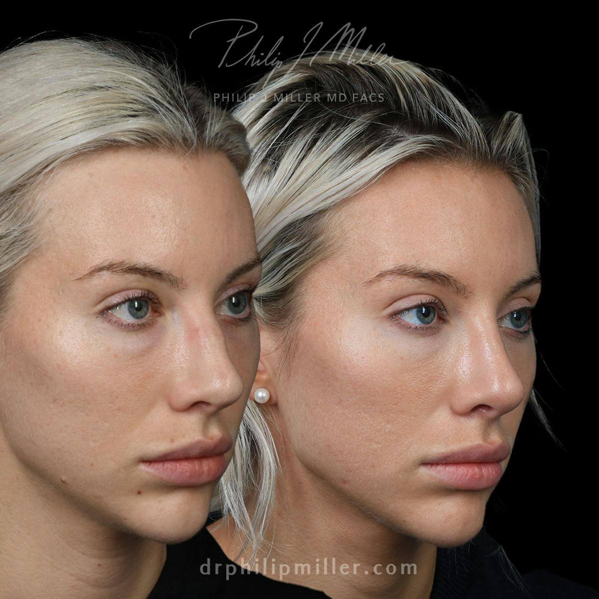 Rhinoplasty/NatraNose Before & After Gallery - Patient 172429 - Image 1