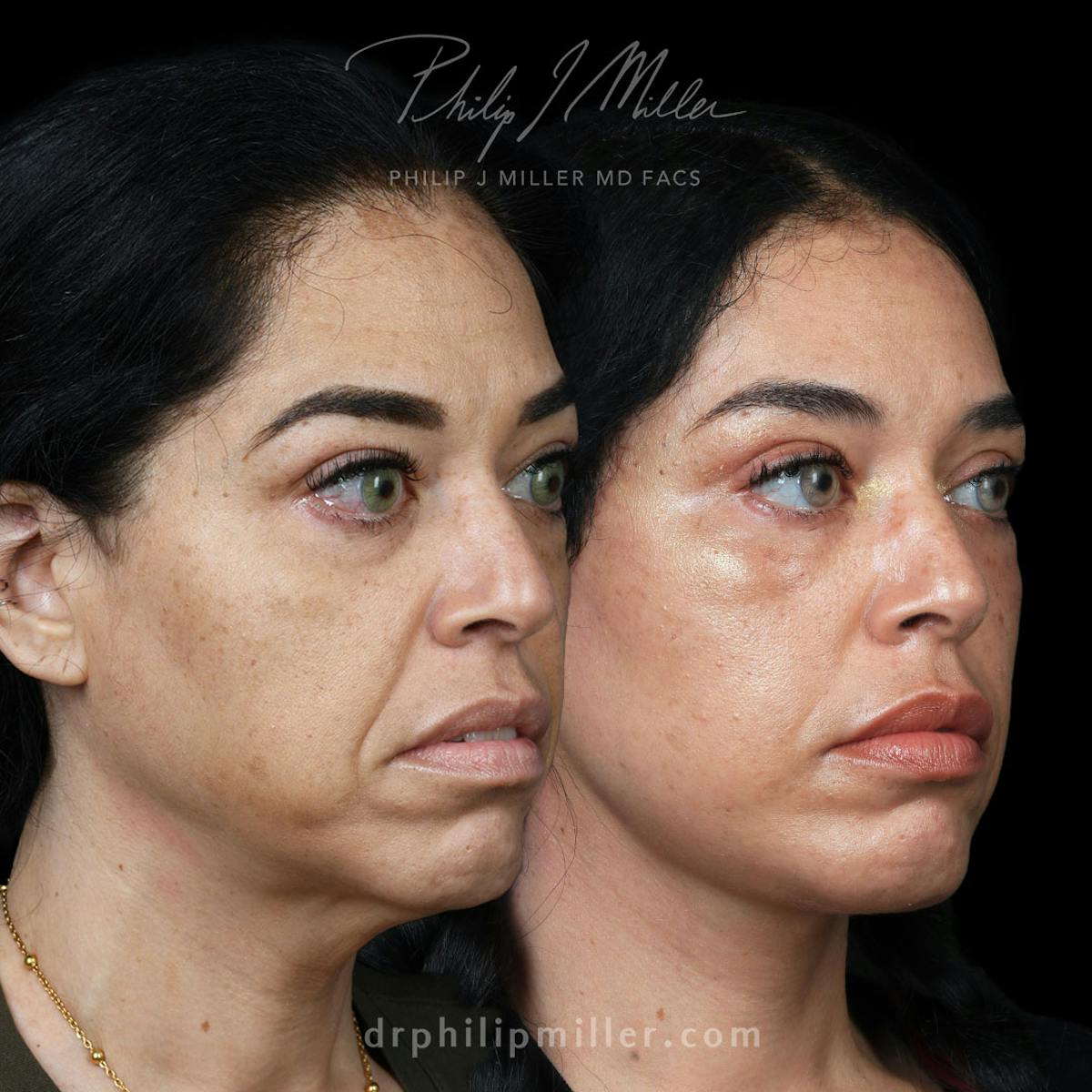 Facelift/NatraLift Before & After Gallery - Patient 227860 - Image 2
